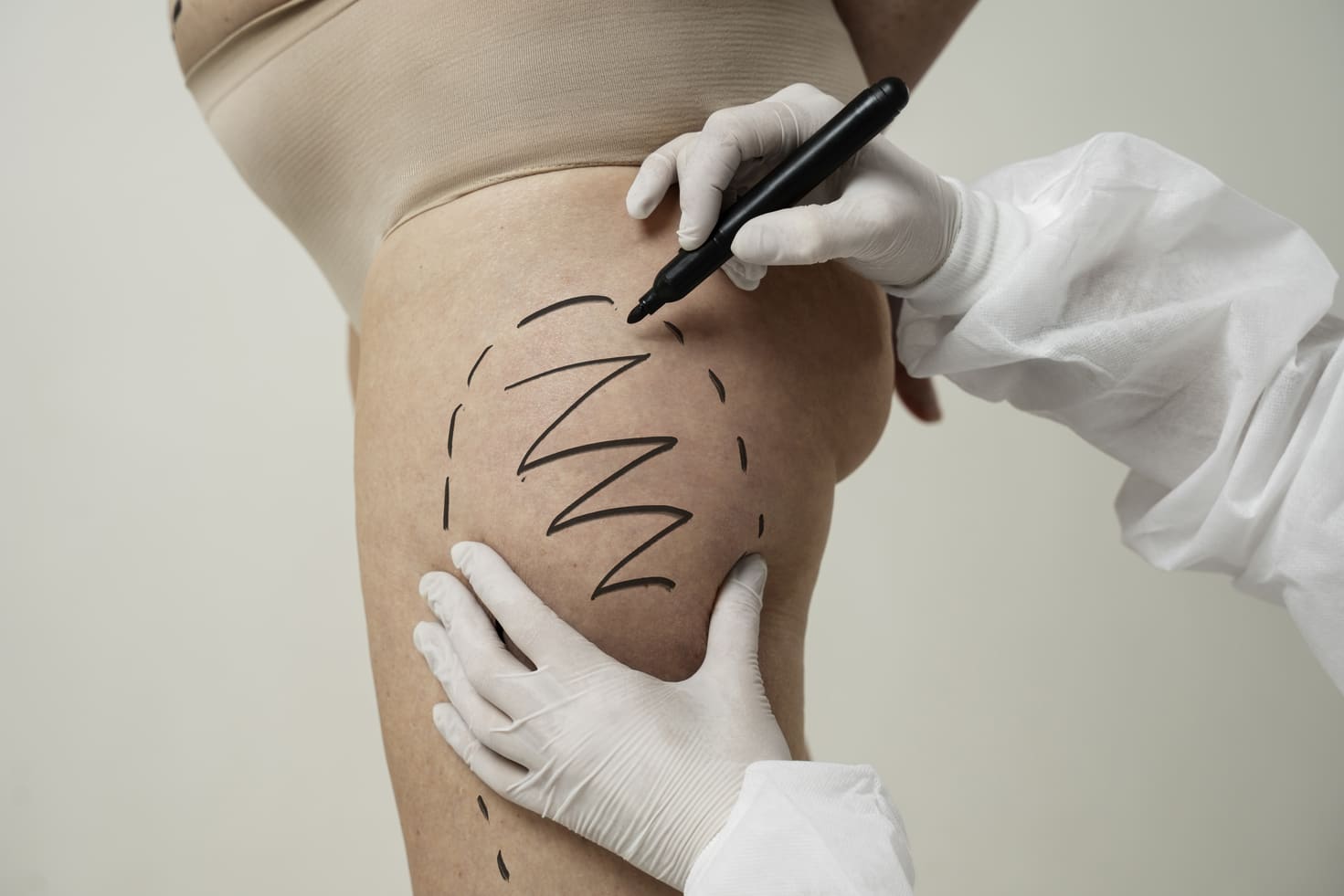 Cosa è la VaserLipo a Torino - Massimo Luni Medicina Estetica